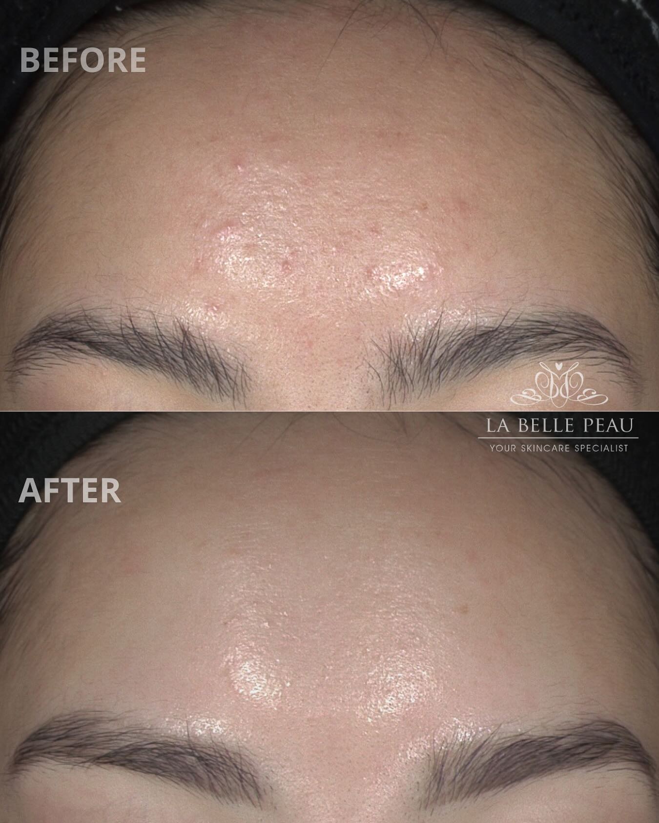 Before and after — forehead congestion and texture