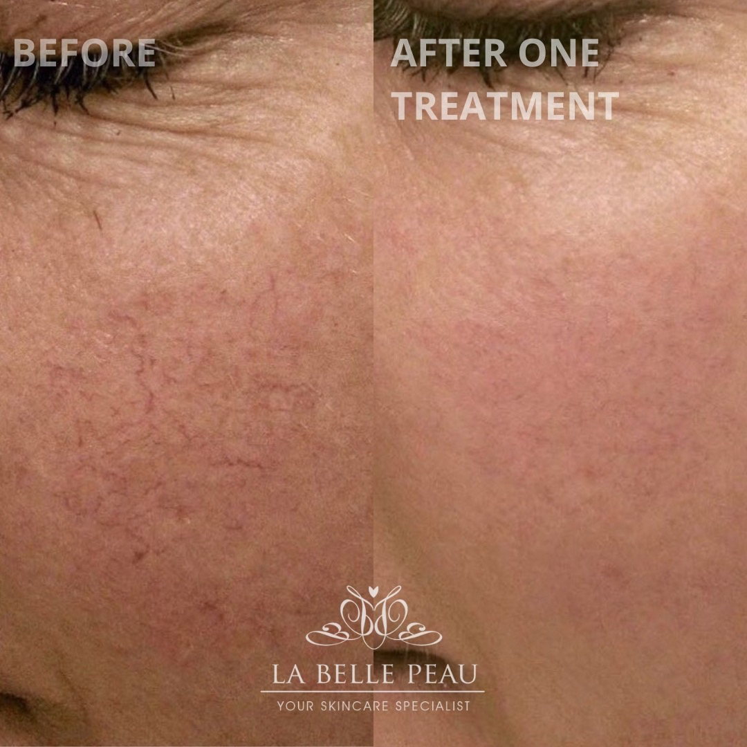 Before and after — facial capillaries after one treatment