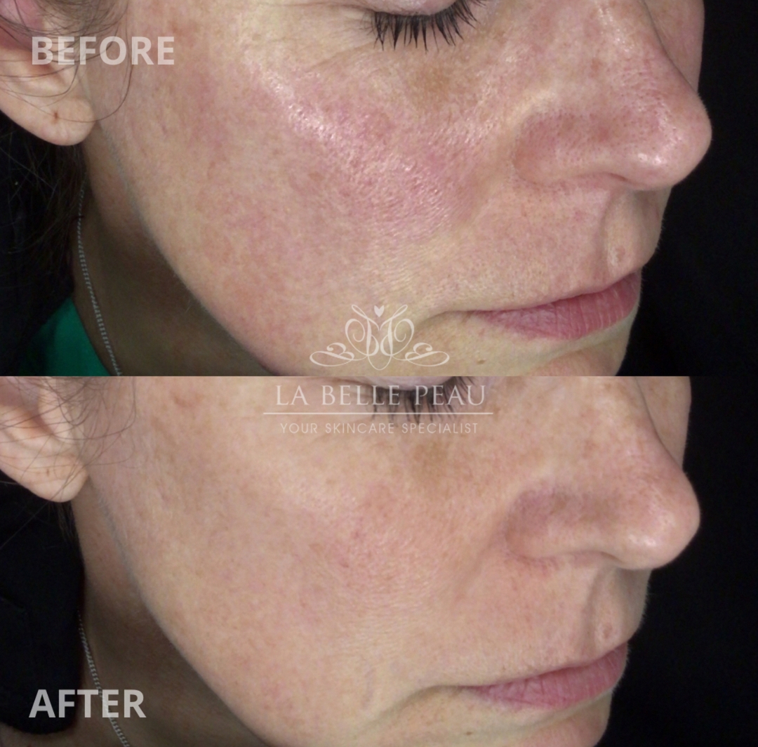 Before and after — pigmentation and redness on the cheek
