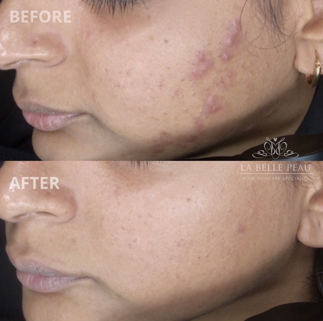Before and after — acne scarring and pigmentation