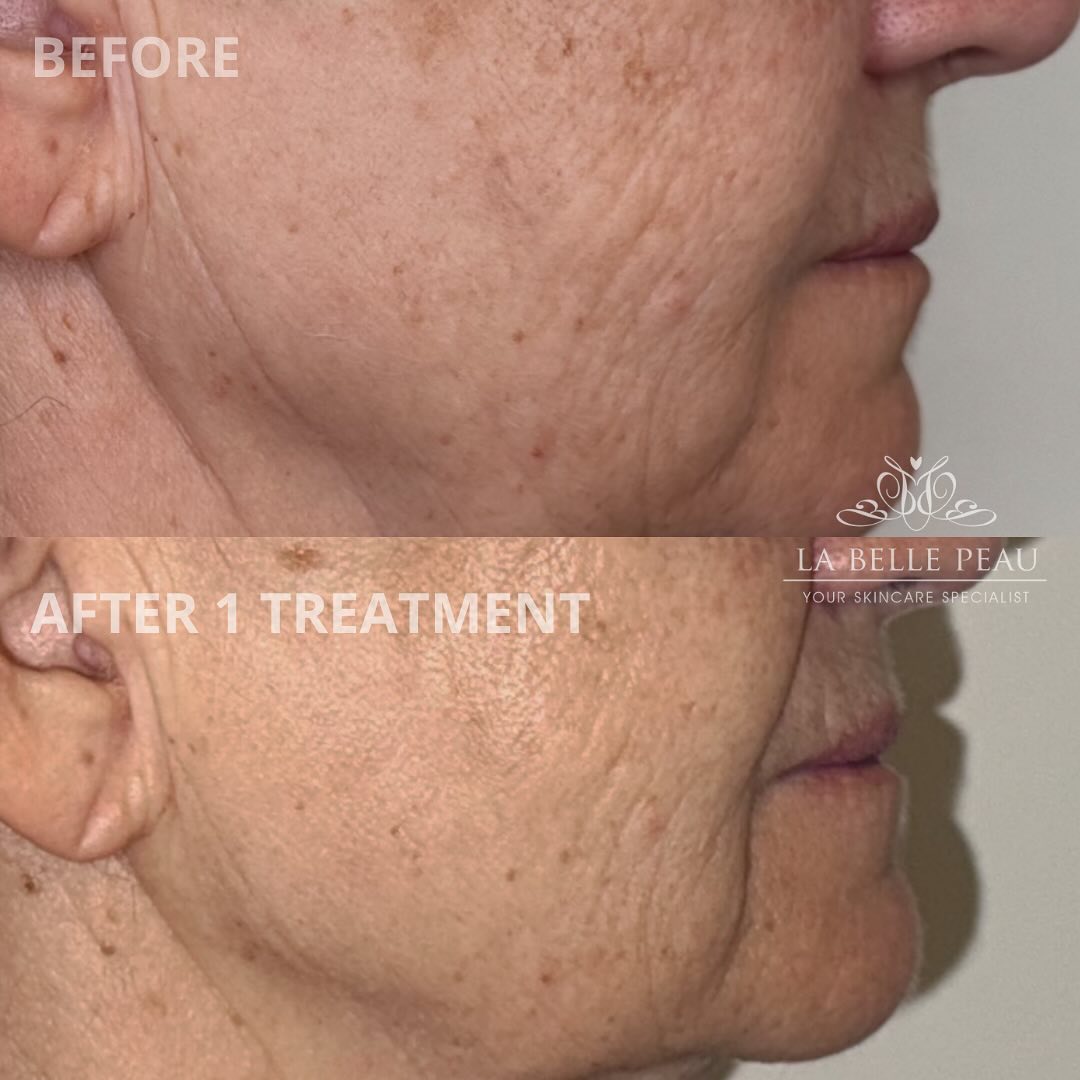 Before and after — skin texture and firmness after one treatment
