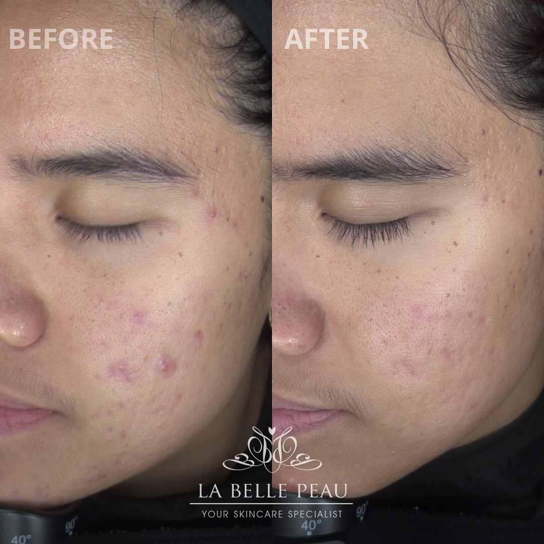 Before and after — acne and congestion clearing