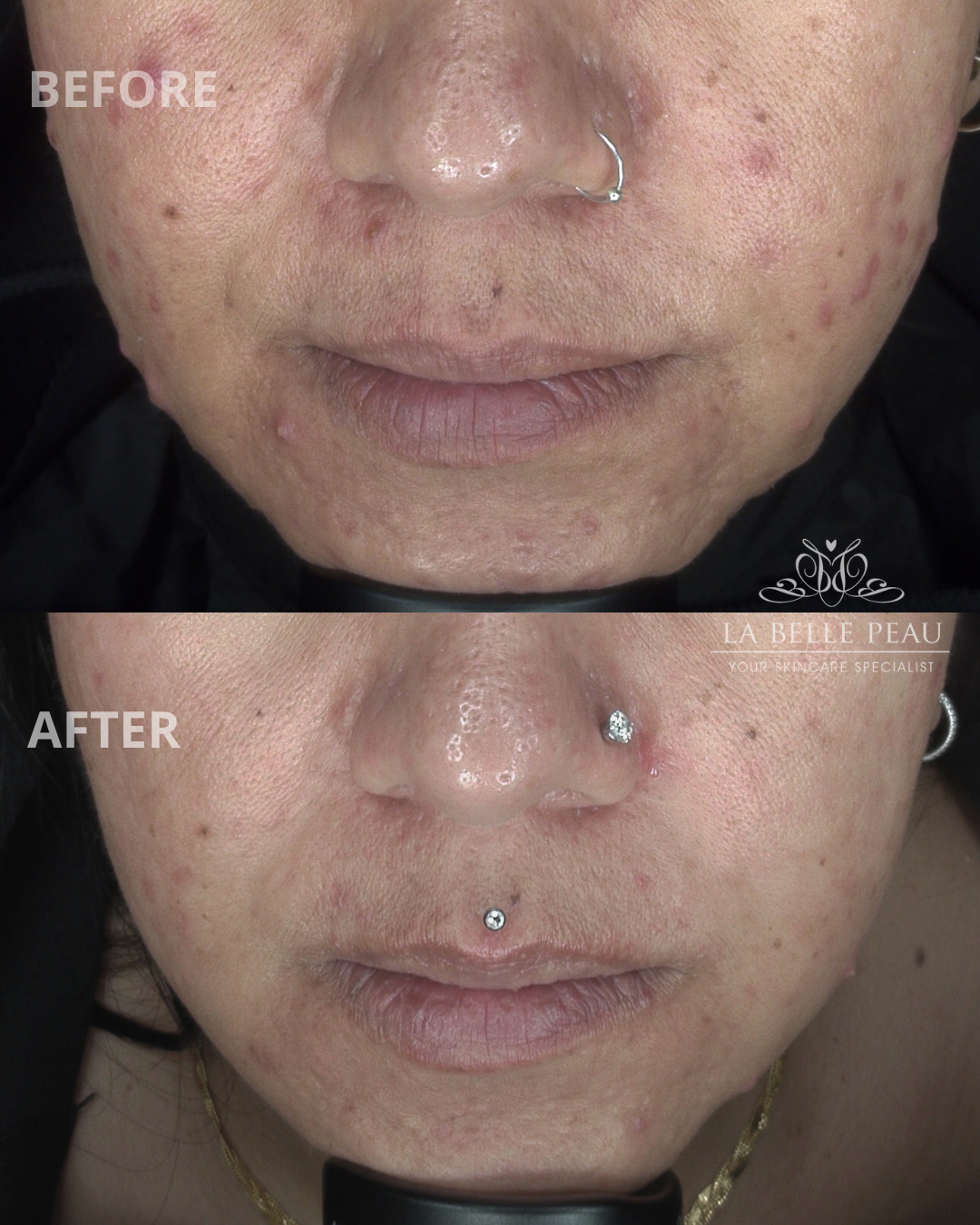 Before and after — active acne clearing