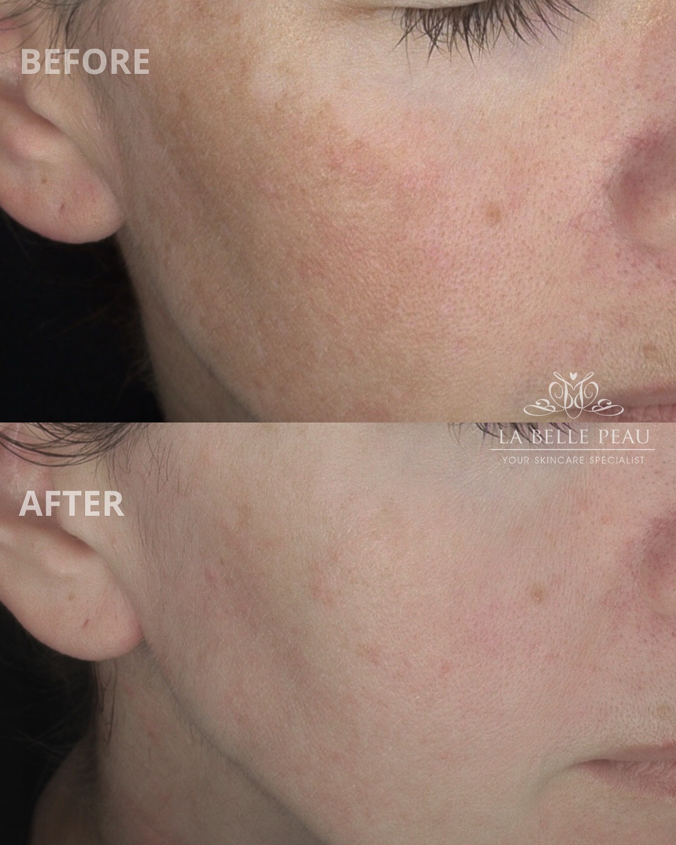 Before and after — pigmentation and even skin tone